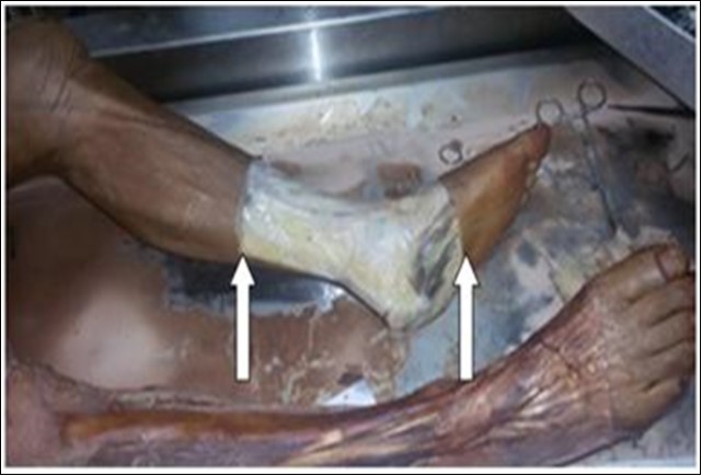  Removal of the skin and subcutaneous tissues 15 cm proximal to the medial malleolus to the midplantar surface of the foot.