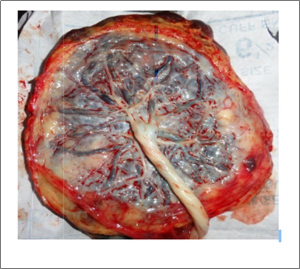  Round shape placenta (Photographed)