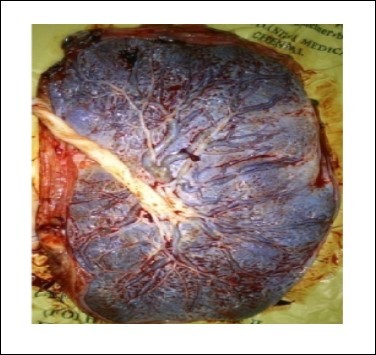  Oval Shape placenta (Photographed)