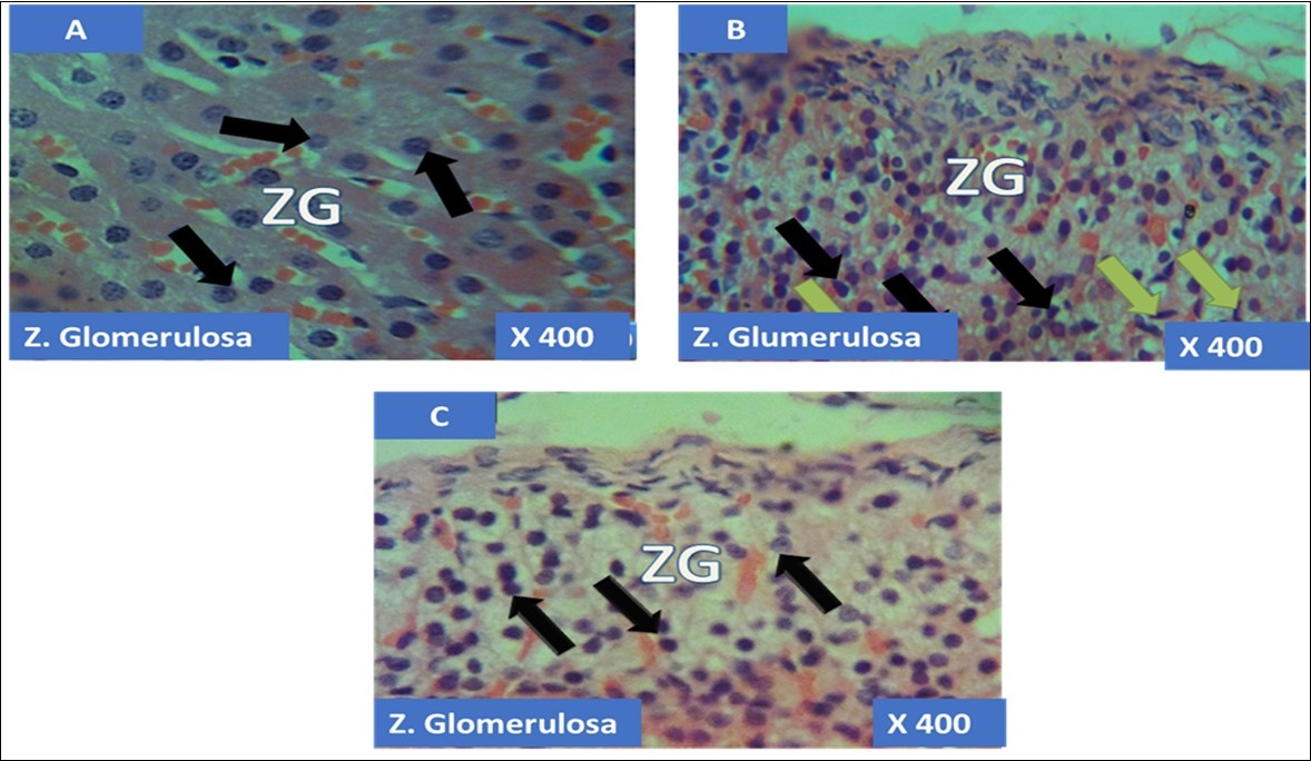  showing the cellular layer of Zona Glomerulosa of Adrenal gland group A (control), group B (T1) and group C (T2). The evenly distributed normal columnar cells with dark nuclei in A (black                   arrows), evenly distributed normal pyramidal cells (black arrows) with few obliterated cells (green                     arrows) in B and in C, the black arrows pointing to  the evenly distributed normal polydhedral cells (black arrows) having long, straight cords of large cells, swollen with lipid droplets. H&E x400 