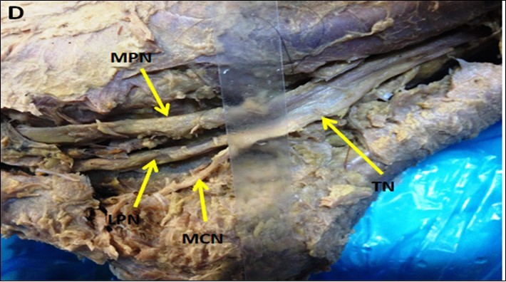  showing PTN bifurcates inside the tarsal tunnel (Type II PTN)