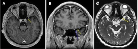  (A) Axial post-gadolinium T1-weighted MRI demonstrating the T1 hypointensity in the left anterior clinoid process (yellow arrow). (B) Coronal post gadolinium T1-weighted MRI with two arrows outlining a clearly delineated air-filled space without a hematoma or traumatic lesion to optic nerve just superior to the tip of blue arrow. (C) Axial T2-weighted FIESTA-C MRI showing T2 hypointensity in the left anterior clinoid process (yellow arrow).