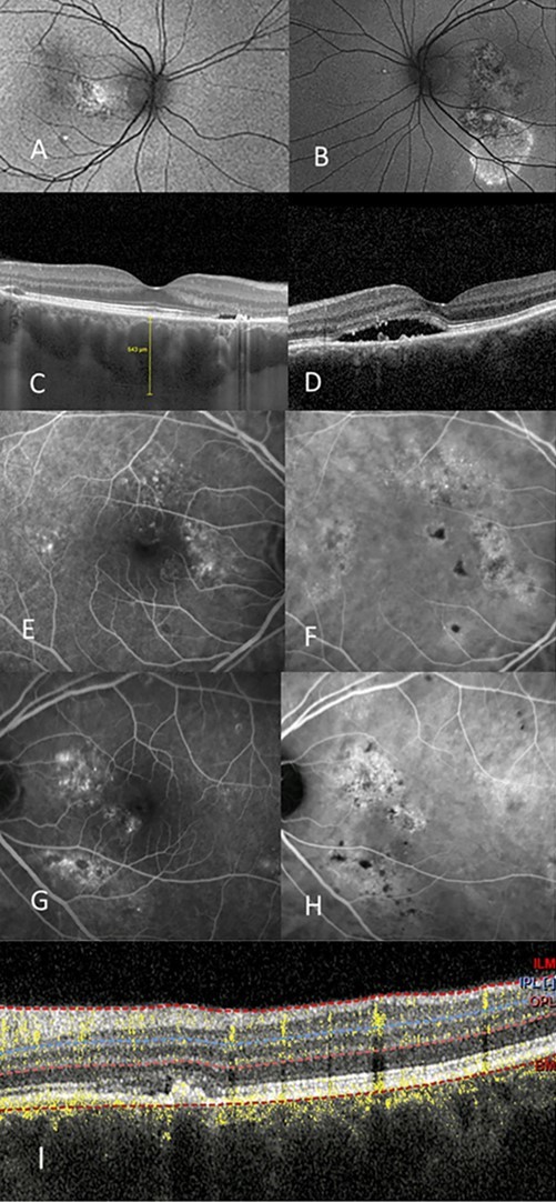 (A),(B) autofluorescent discontinuity, peripheral, right eye, (A), left eye, (B). (C),(D) OCT shows pachychoroid, pachy vessels, intraretinal and subretinal fluid, right eye (C), left eye (D). (E) right eye IVFA with temporal occult and pinpoint leakage, (F) right eye ICG shows hyperfluorescence. (G) left eye shows nonspecific leakage nasally with corresponding ICG leakage (H). (I) shows OCTA with early CNV superior macula that is associated with the serous detachment of the macular.