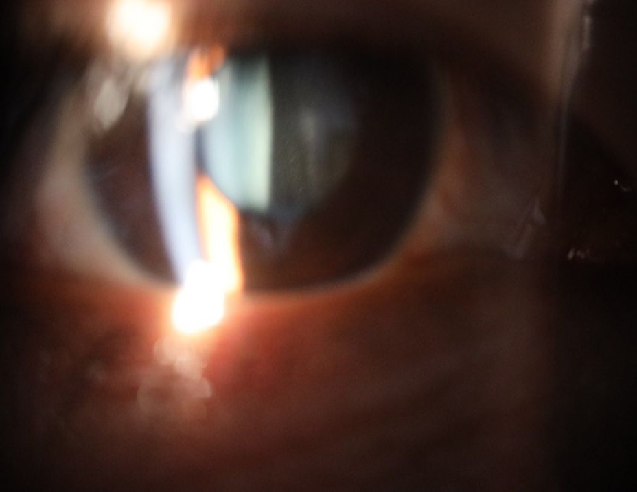 The anterior segment of the right eye shows the vitreous with greater transparency. The cornea and lens, as well as the anterior chamber, are in good condition.