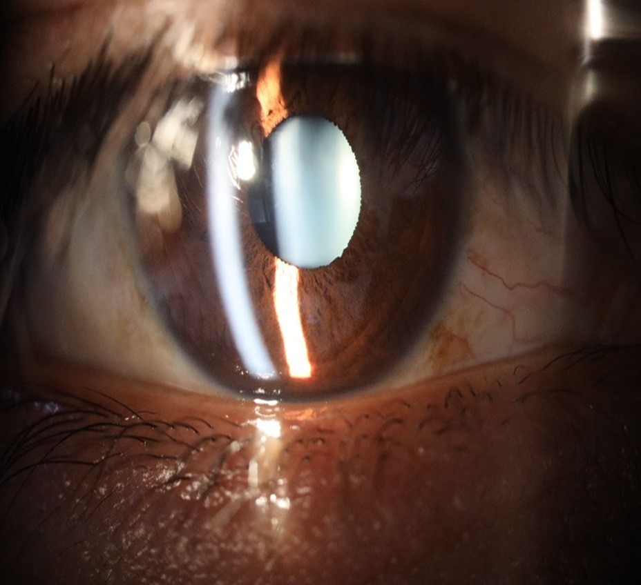 The macro photograph of the right eye shows us a cornea, anterior camera, and crystalline lens in very good condition.