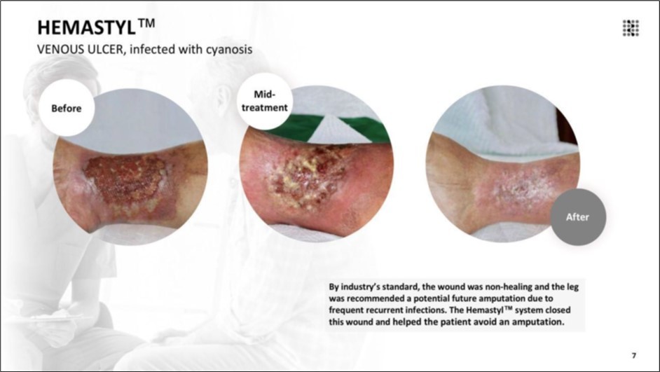 By industry’s standard, the wound was non-healing and the leg was recommended for potential future amputation due to frequent recurrent infections. The Hemastyl™ System closed this wound in 50 days and helped the patient avoid an amputation.