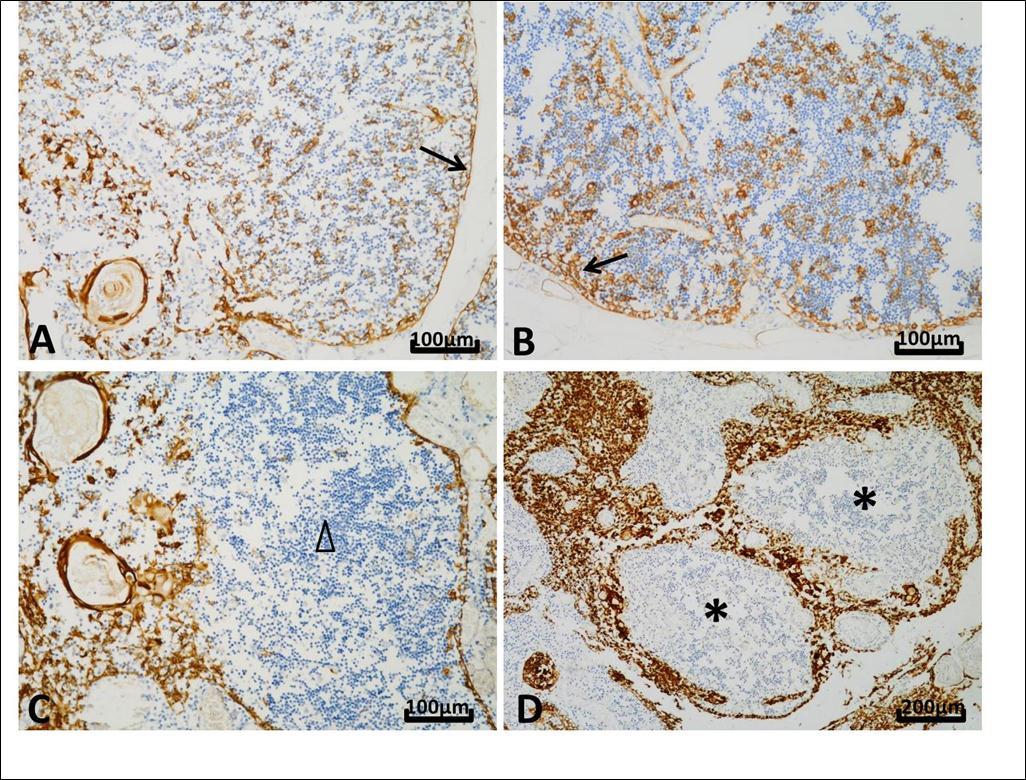  Different patterns of CK19 expression in thymuses. Nuclei were stained in blue by hematoxylin and positive reaction appeared brown. A, Thymus from a 16-month child who died of interstitial pneumonia. The whole epithelial network expressed CK19 forming a meshwork structure in the cortex and the medulla (original magnification, ×200). B, The number of CK19-positive subcapsular cells    was more in the thymus from a female of 29 years old with SUDA, who diagnosed as thrombocytopenic purpura and died of infectious shock, than that seen in the child thymus (original magnification, ×200). C, Thymus from a 27-year old man with cardiac sudden death and accompanied by adrenal pheochromocytoma. Reactivity with CK19 was little or absent in the medulla (△) (original magnification, ×200). D, A female of 20 years old who died of Crohn’s disease with perforation. B cells presented nodular hyperplasia and formation of lymphoid follicles (*). Their presence was accompanied by a disorderly arrangement and hypertrophy of medullary epithelial cells. The pushed epithelial cells were packed and showed strong CK19 expression (original magnification, ×100).