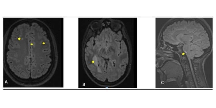 Journal of Neurological Research And Therapy-ADEM