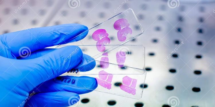 Intestinal tuberculosis diagnosis